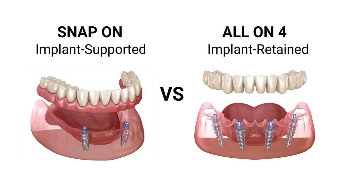 All-on-4 vs. Snap-On Dentures